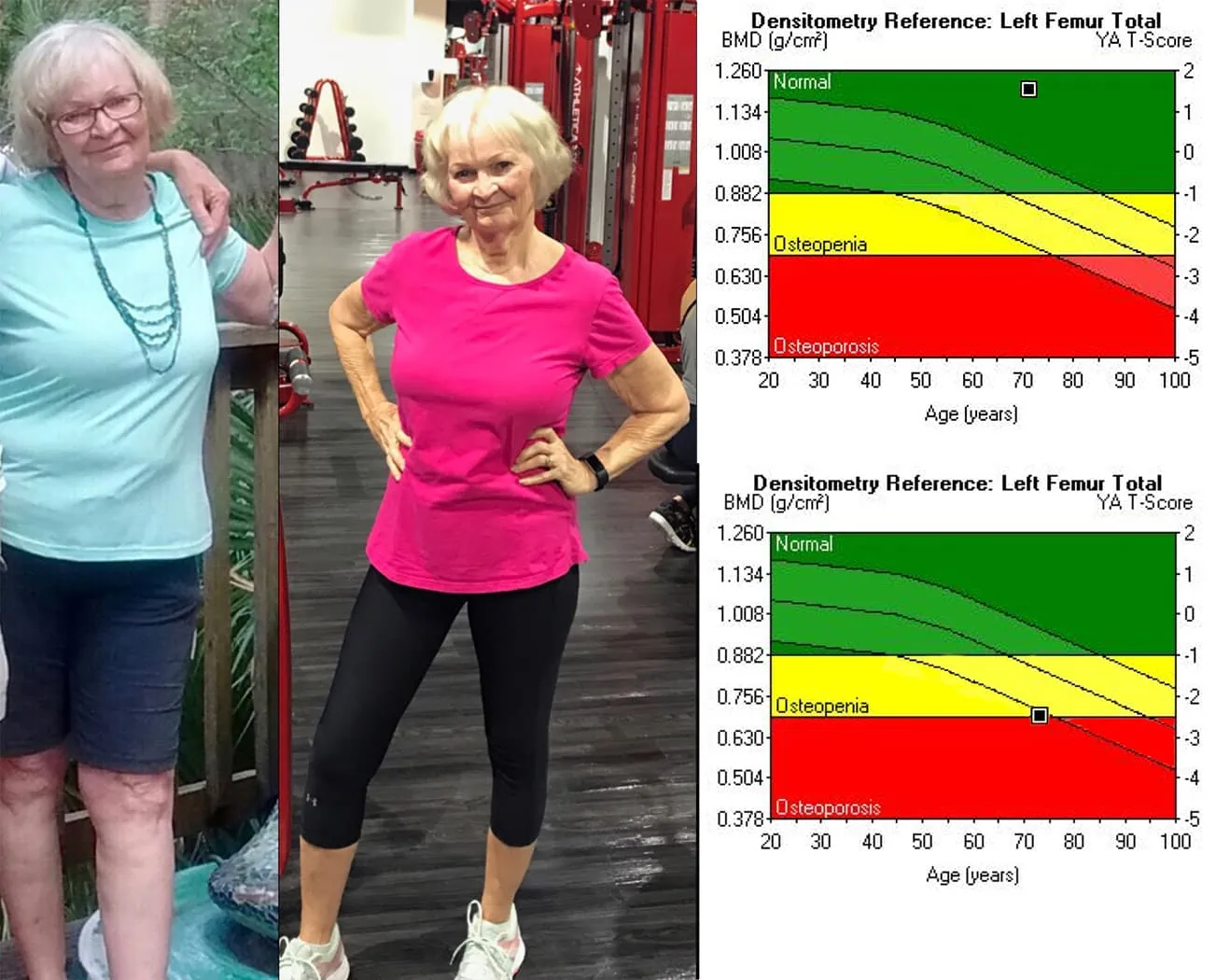 Marie Bone Growth Before and After