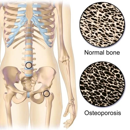 Understanding Osteoporosis Section At Apex Fit in Orlando FL