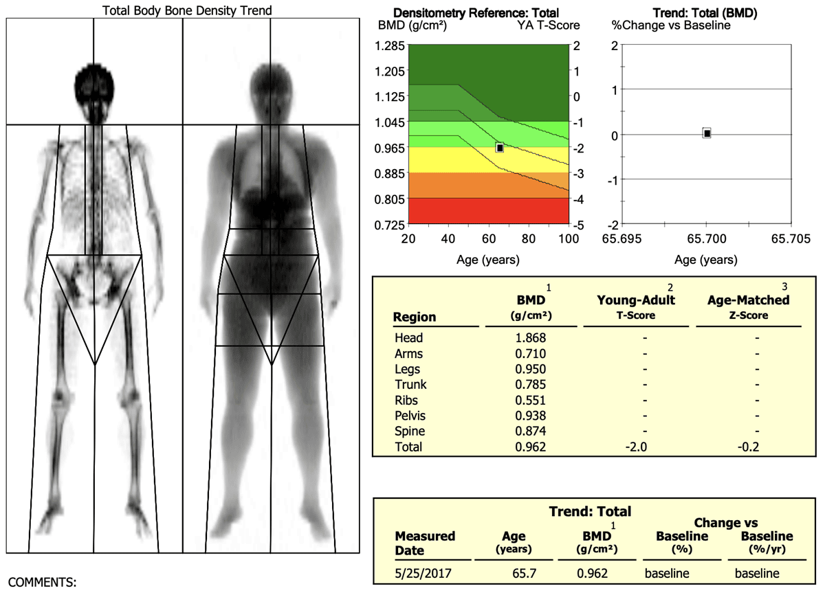 TScore dexa scan